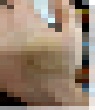 太ももの皮膚を手のひらに移植した結果がこちら…