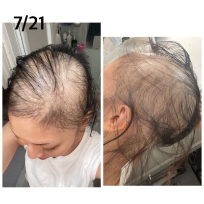 【コロナ】モデルナのワクチンを接種後に髪の毛が抜けてしまった女性が現れる
